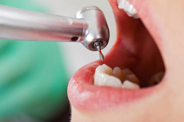 Best Emergency Wisdom Tooth Extraction in Bakersfield Country Clu, CA